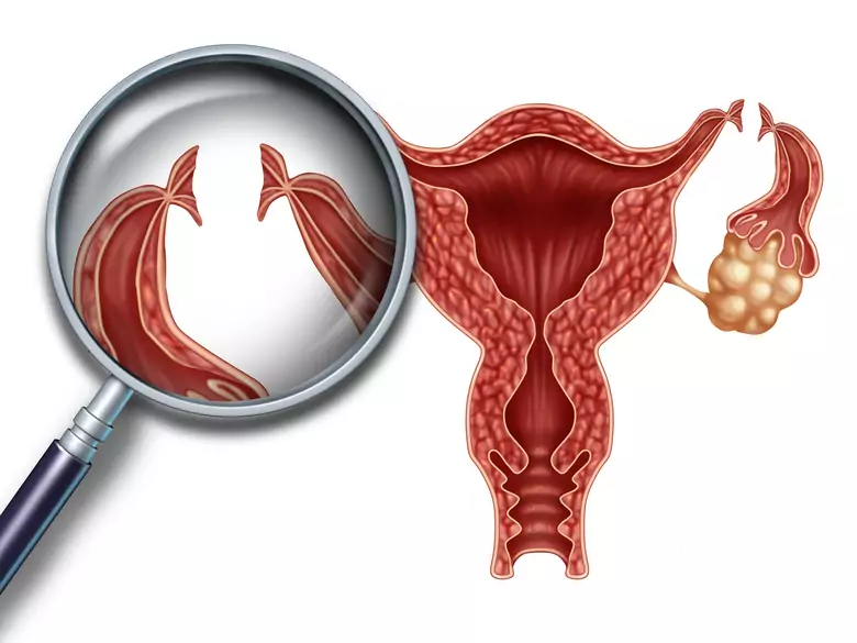 Nowy test pozwoli wcześnie wykrywać raka jajnika?