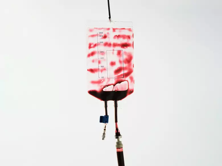 Trombofilia, ciąża, ryzyko poronienia